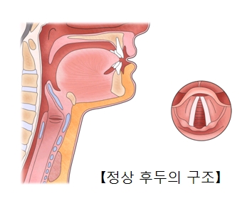 정상 후두의 구조 예시