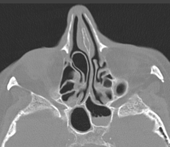 코의 방사선검사(CT) 사진