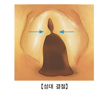 성대결절 사진 예시