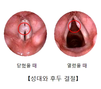 후두결절이 발병한 성대의 다혔을때와열렸을때의 내시경사진