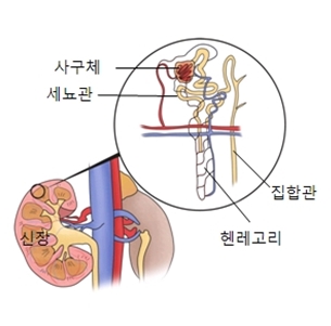 신장안쪽 사구체 세뇨관 집합관 헨레고리등으로 이루워진 신부전의 예시