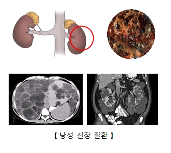 낭성신장질환의 예시및 x-ray사진