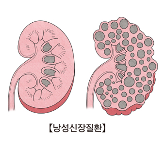 낭성신장질환의 예시