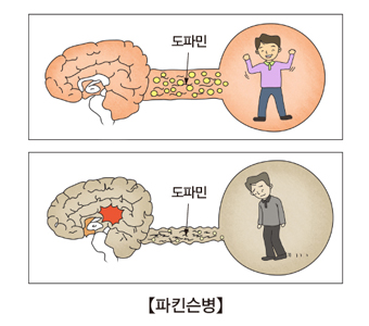 파킨슨병-정상적인도파민계 신경과 파킨슨병에 걸린 도파민계 신경 예시