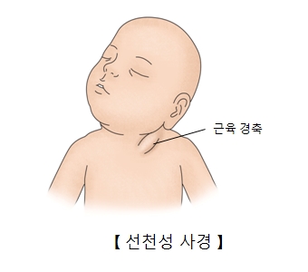 선천성사경- 목주변에 근육경축이 일어난 신생아의 모습 예시