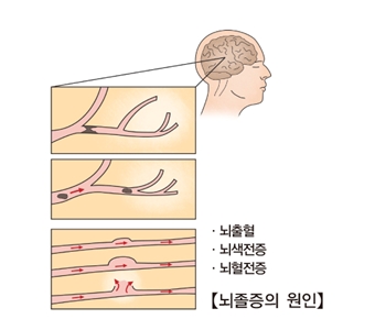 뇌졸증의 원인-뇌출혈,뇌색전증,뇌혈전증 사진예시