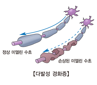 다발성 경화증-정상 미엘린수초와 손상된 미엘린 수초