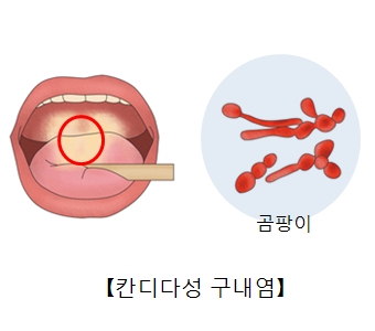 칸디다성 구내염에 감염된 혀와 곰팡이균