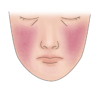 양 볼에 뺨을맞은것처럼 홍반이 나타나있는 얼굴