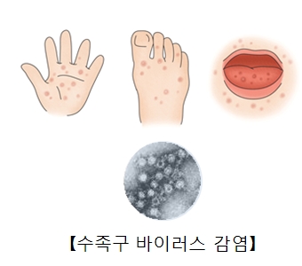 손, 발의 발진과 입안의 궤양성 병변과 수족구바이러스균의현미경사진