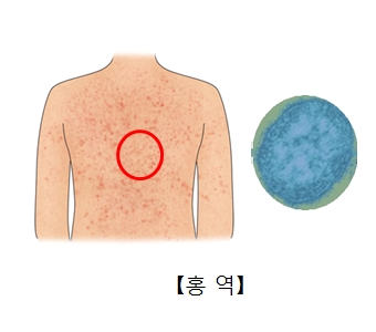 홍역에걸려 피부발진이 일어난 사람의 몸과 홍역바이러스균의모습