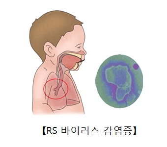 소아의 호흡기구조와 RS바이러스균의현미경사진