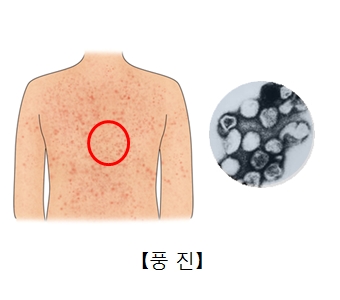 풍진에의해 온몸에 발진이 일어난 사진과 루벨라바이러스 현미경사진