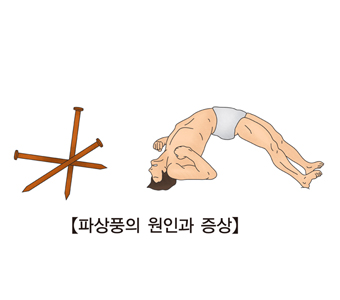 파상풍의 원인과증상 못,전신경련으로 고통받는남성