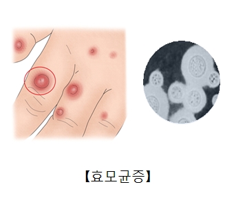 효모균에 감염된 손가락과손등과 효모균현미경사진