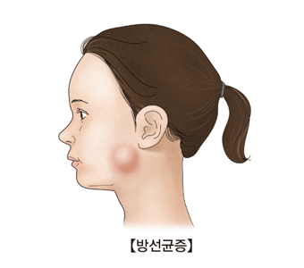 방선균증으로인해 턱 밑이 부어오는 여성