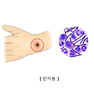 손목에 발병한 탄저병과 탄저균의모습