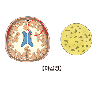 뇌의단면도와 대뇌부분을 확대해 그곳에서 서식하고있는 변종 프리온