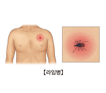 남성의왼쪽가슴윗쪽에진드기가 붙어있음