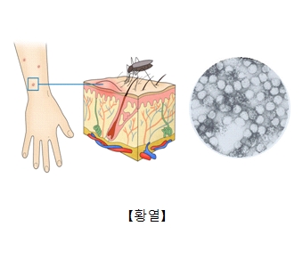 모기가 손등에서 피를 빨고있는모습과 아르보바이러스