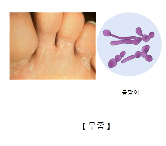 발가락 사이 무좀 및 곰팡이 균의 예