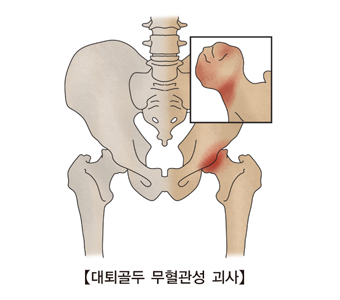 대퇴골두 무혈관성 괴사 골격도