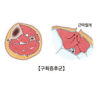 근막절개된 구획증후군의 예시