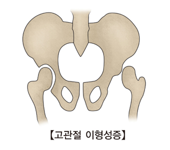 고관절 이형성증에 걸린 골격의 사진 예시