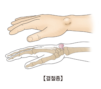 손목에 결절종이 발병한 사진과 해부도