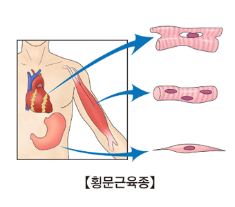 심장,위장,근육에 발병된 횡문근육종의 모습