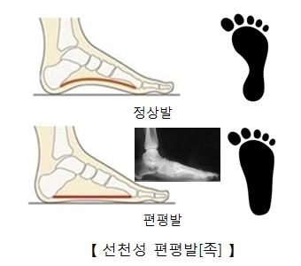 정상발의발자국과옆에서본모습및선천성편평발발자국과 옆에서 본모습