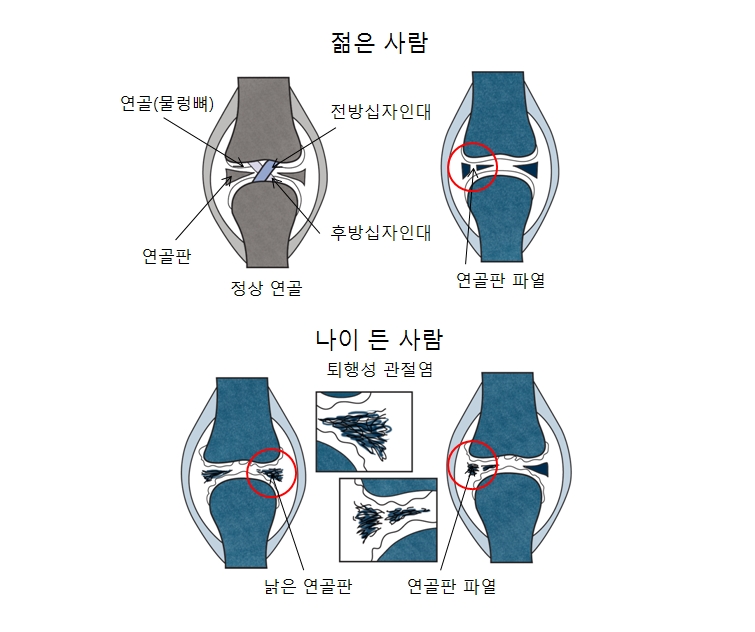 정상연골과 물렁뼈,연골판,후방십자인대,전방십자인대의 위치, 젊은사람의연골판파열사진예시,나이든사람의 낡은연골판과 연골판 파열사진예시