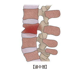 척수한부분에 골수염이 걸린 사진 예시