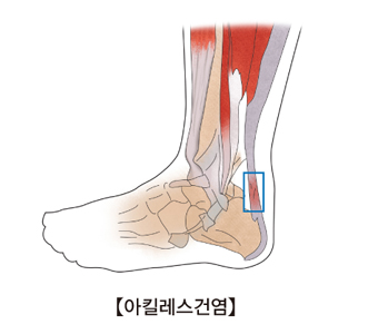 아킬레스 건염에 걸린 해부도 사진예시