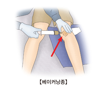 무릎 뒤쪽 안쪽에 물혹이 생긴 낭종을 주사기로 뽑아내고있는 모습