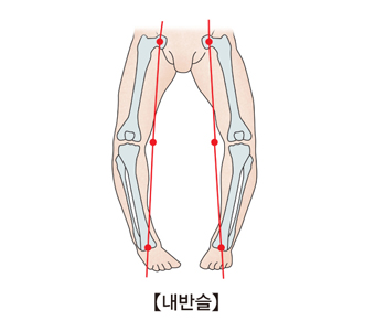 다리의변형을 일으킨 사진예시(오형다리)