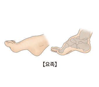 요족에걸린발모양과 해부도사진 예시
