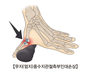 엄지 중수지관절측 부인대손상 사진 예시