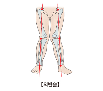 외반슬에 걸려 차렷자세로 서있을때의 모습