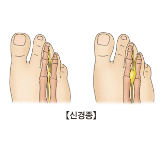 신경종-정상적인발의 해부도와 신경종에 걸린 발의 해부도 그림 예시