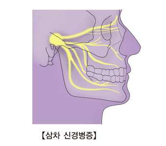 삼차 신경병증-삼차신경통의 통증 방향