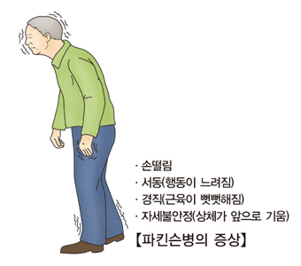 파킨슨병의증상-손떨림,서동(행동이느려짐),경직(근육이 뻣뻣해짐),자세불안정(상체가 앞으로 기움)