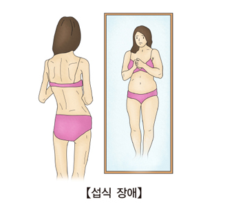 섭식장애-마른여성이 거울을보고 자신의모습은 뚱뚱하다 생각함