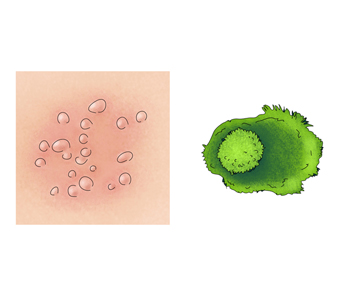 피부에생긴대상포진과 대상포진세포