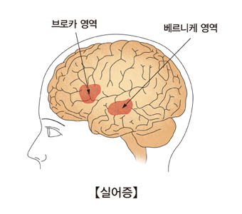 실어증-브로카영역,베르니케영역 위치