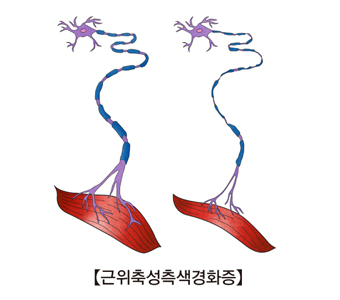 근위축성측색경화증-정상신경모습과 근위축성측색경화증의신경모습