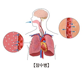 잠수병의 예시