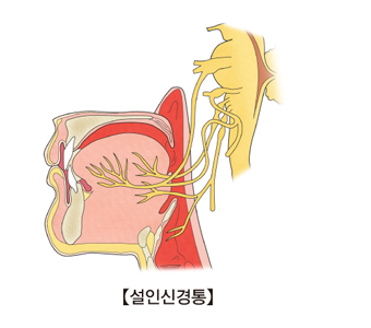 설인 신경통 사진 예시