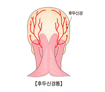 후두신경통-후두신경 모습 예시