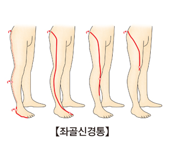 좌골신경통의 통증 위치